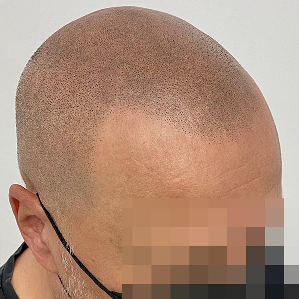 Dopo il trattamento di tricopigmentazione - lato destro