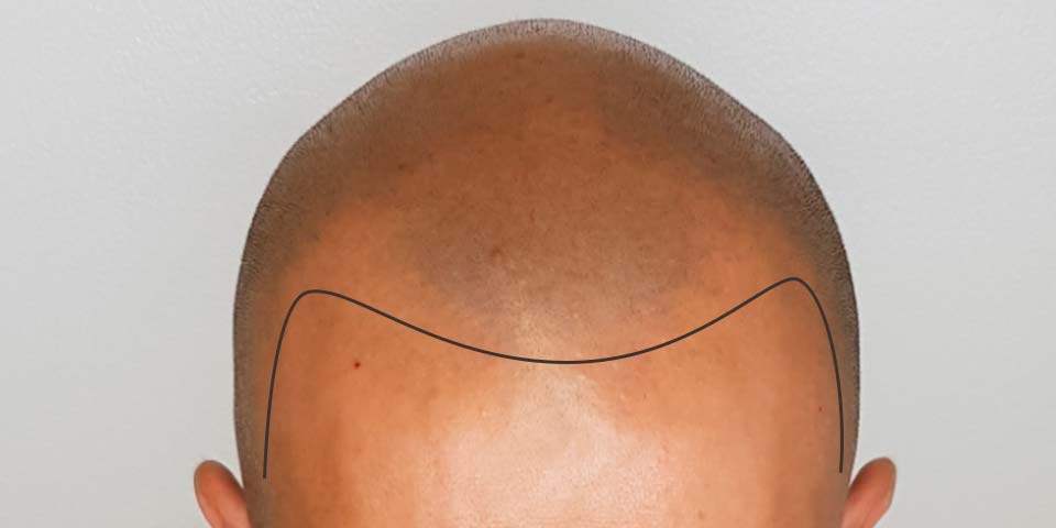 Tricopigmentazione studio di linea di attaccatura dei capelli