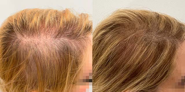 Tricopigmentazione donna del cuoio capelluto per effetto rinfoltimento