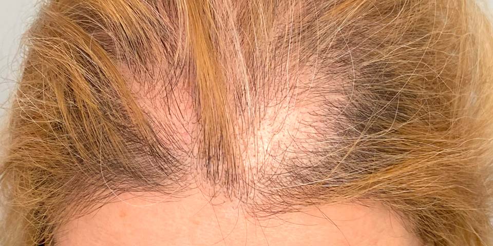Trattamento estetico donna per diradamento dei capelli - Natalie Halova