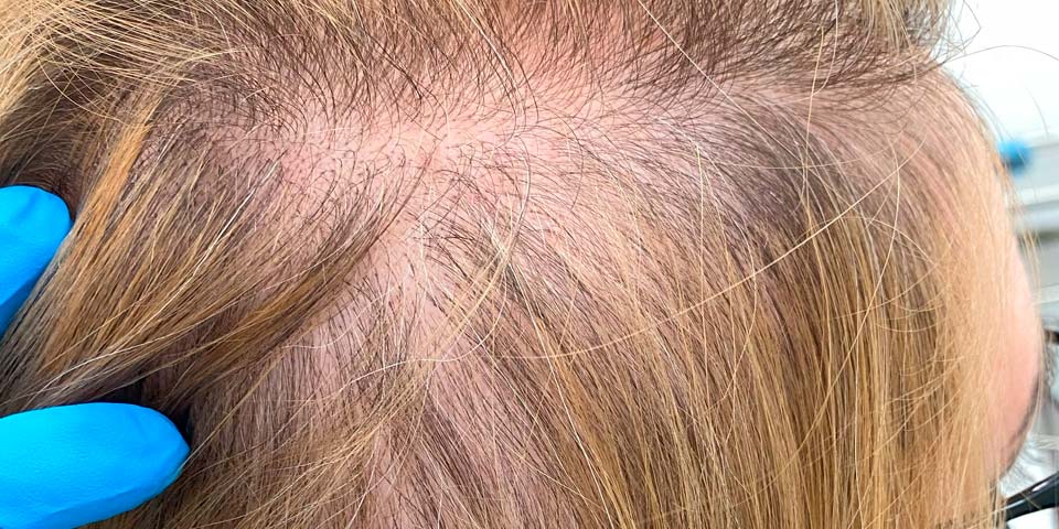 Trattamento estetico donna per diradamento dei capelli - Natalie Halova
